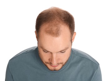 Photo of Man with hair loss problem isolated on white, above view. Trichology treatment