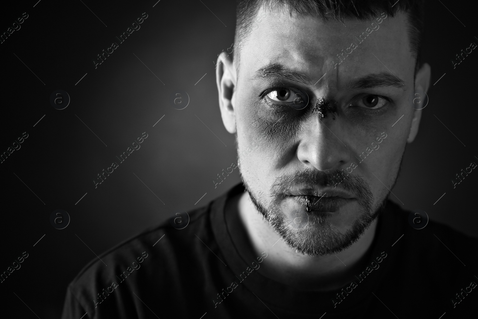 Image of Man with facial injuries on dark background, space for text. Domestic violence victim