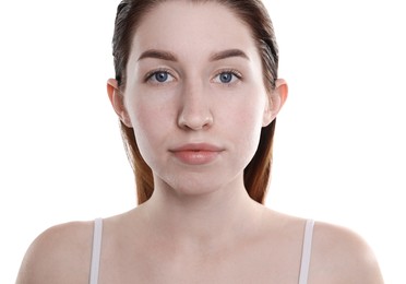 Photo of Young woman with acne problem on white background