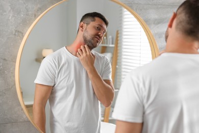 Photo of Man suffering from allergy looking at his neck in mirror indoors