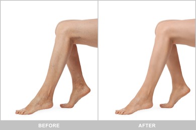 Before and after varicose veins treatment. Collage with photos of woman showing legs on white background, closeup