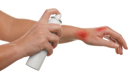 Photo of Woman applying panthenol onto burned hand on white background, closeup