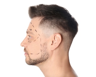 Man with marks on face for cosmetic surgery operation against white background