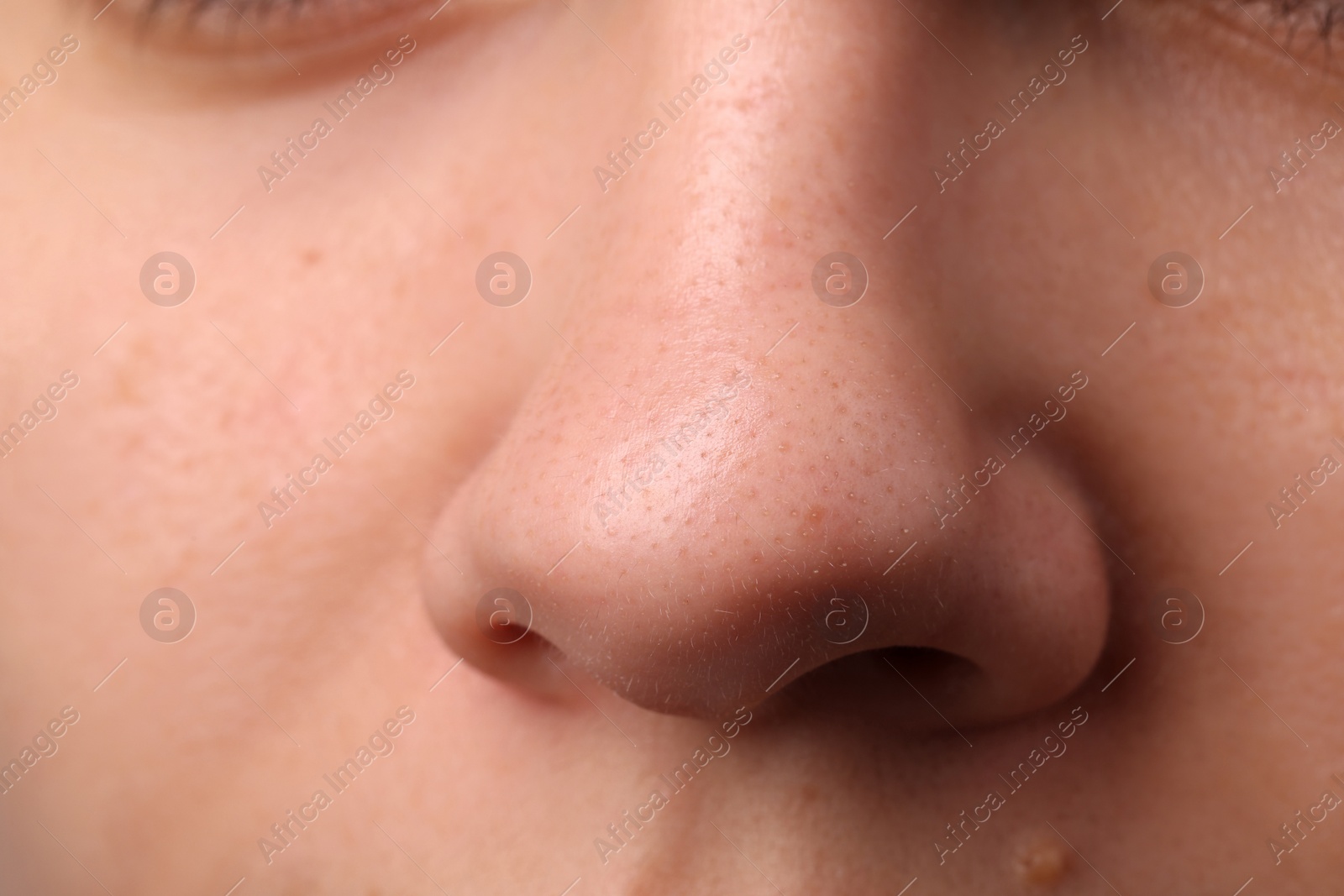 Photo of Young woman with acne problem, closeup view of nose