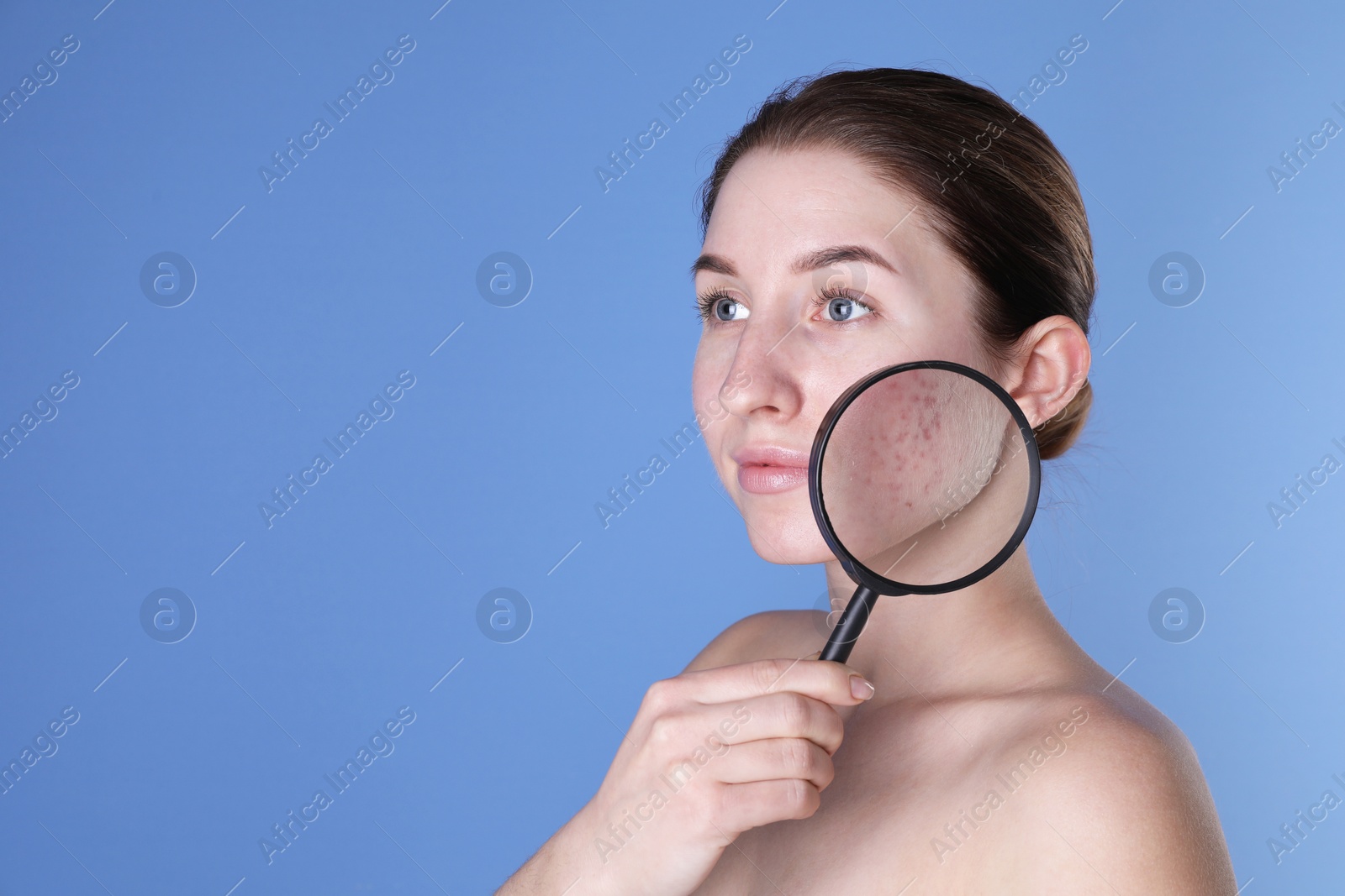 Photo of Young woman with acne problem holding magnifying glass near her skin on blue background. Space for text