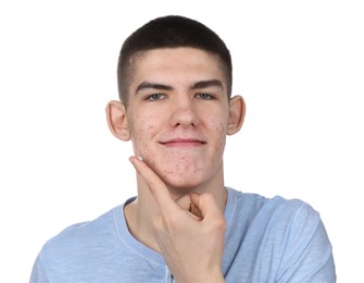 Young man with acne problem applying cosmetic product onto his skin on white background