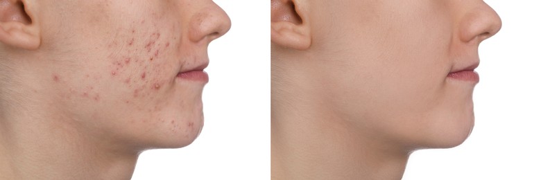 Image of Acne problem. Young man before and after treatment on white background, closeup. Collage of photos