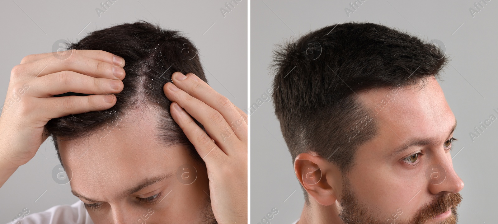 Image of Man showing hair before and after dandruff treatment on grey background, collage