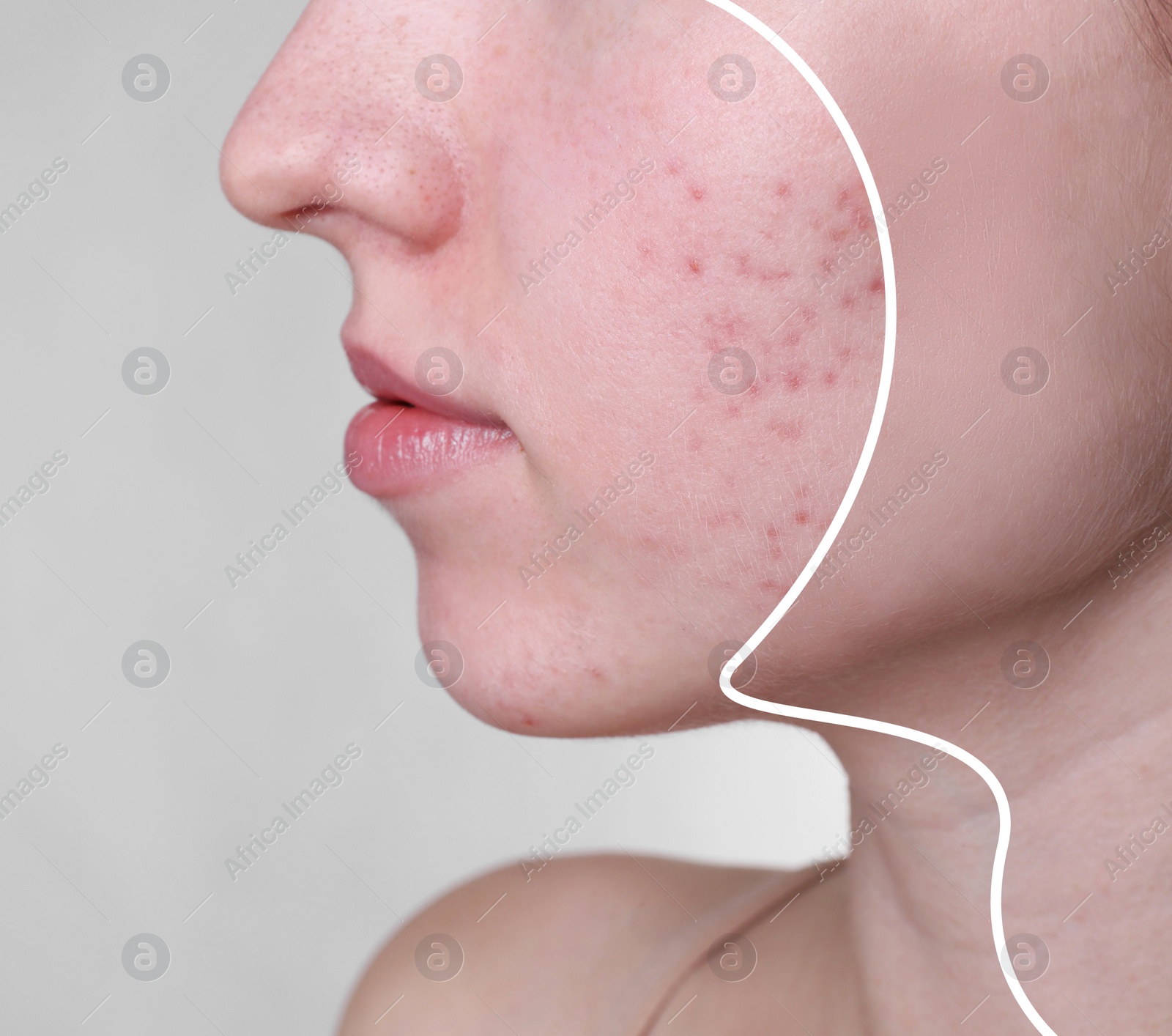 Image of Acne problem, collage. Woman before and after treatment on grey background, closeup