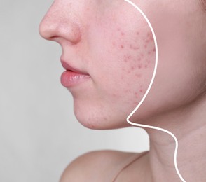 Acne problem, collage. Woman before and after treatment on grey background, closeup