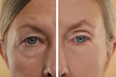 Image of Aging skin changes. Woman showing face before and after rejuvenation, closeup. Collage comparing skin condition