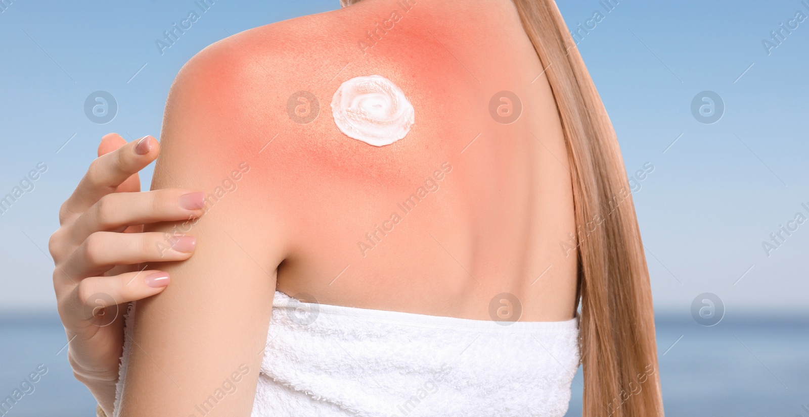 Image of Woman with sunburn near sea, closeup. Skin protection from sun in summer