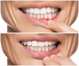 Woman showing gum before and after treatment on white background, collage of photos