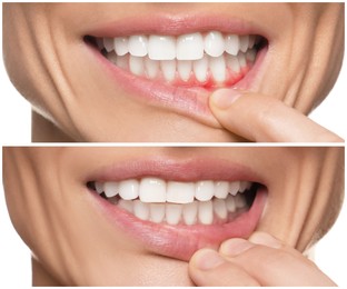 Image of Woman showing gum before and after treatment on white background, collage of photos