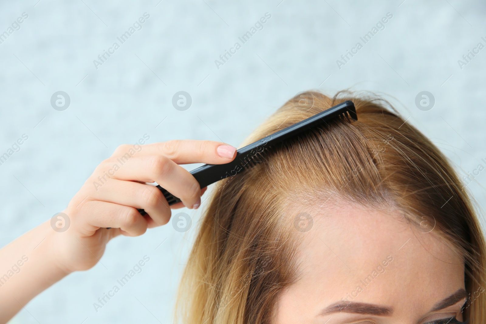 Photo of Young woman with hair loss problem, closeup