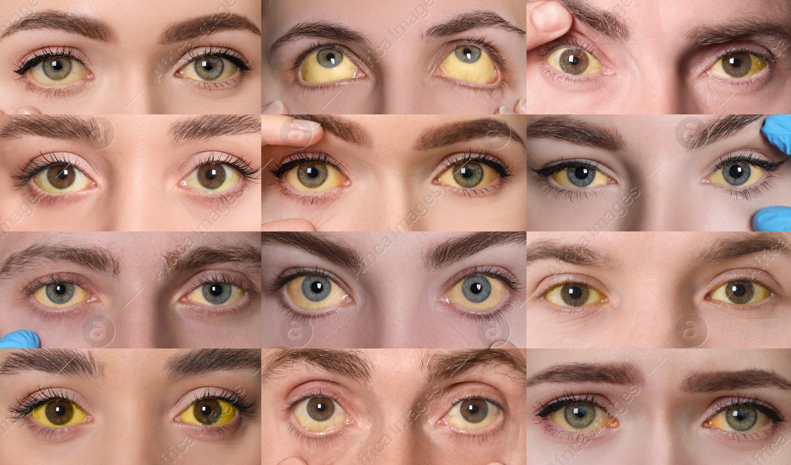 Image of Yellowing of eyes as symptom of hepatitis. Collage with photos of people