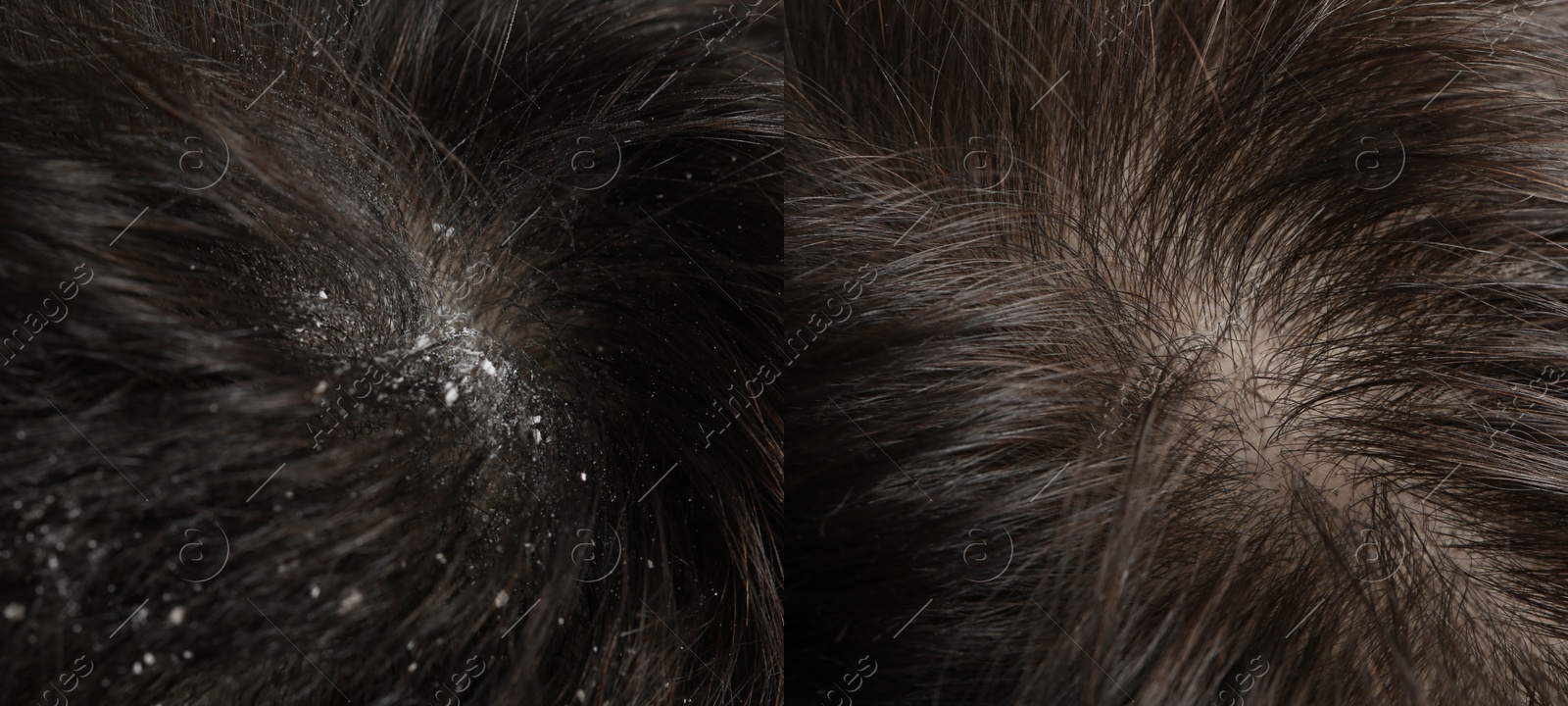 Image of Man showing hair before and after dandruff treatment, collage