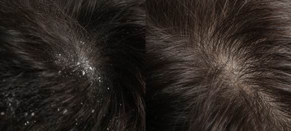 Image of Man showing hair before and after dandruff treatment, collage