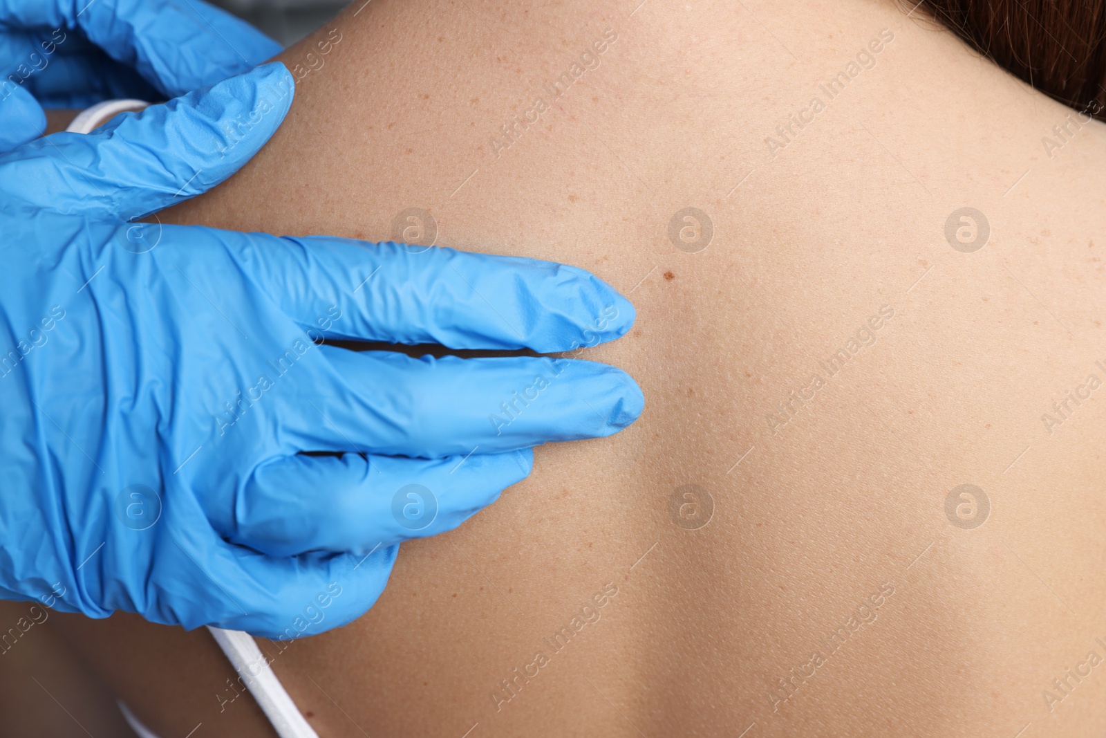 Photo of Dermatologist examining patient's birthmark in clinic, closeup