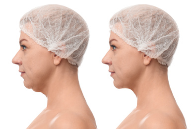 Image of Mature woman before and after plastic surgery operation on white background. Double chin problem