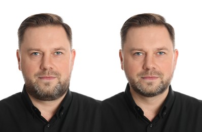 Double chin problem. Collage with photos of mature man before and after plastic surgery procedure on white background