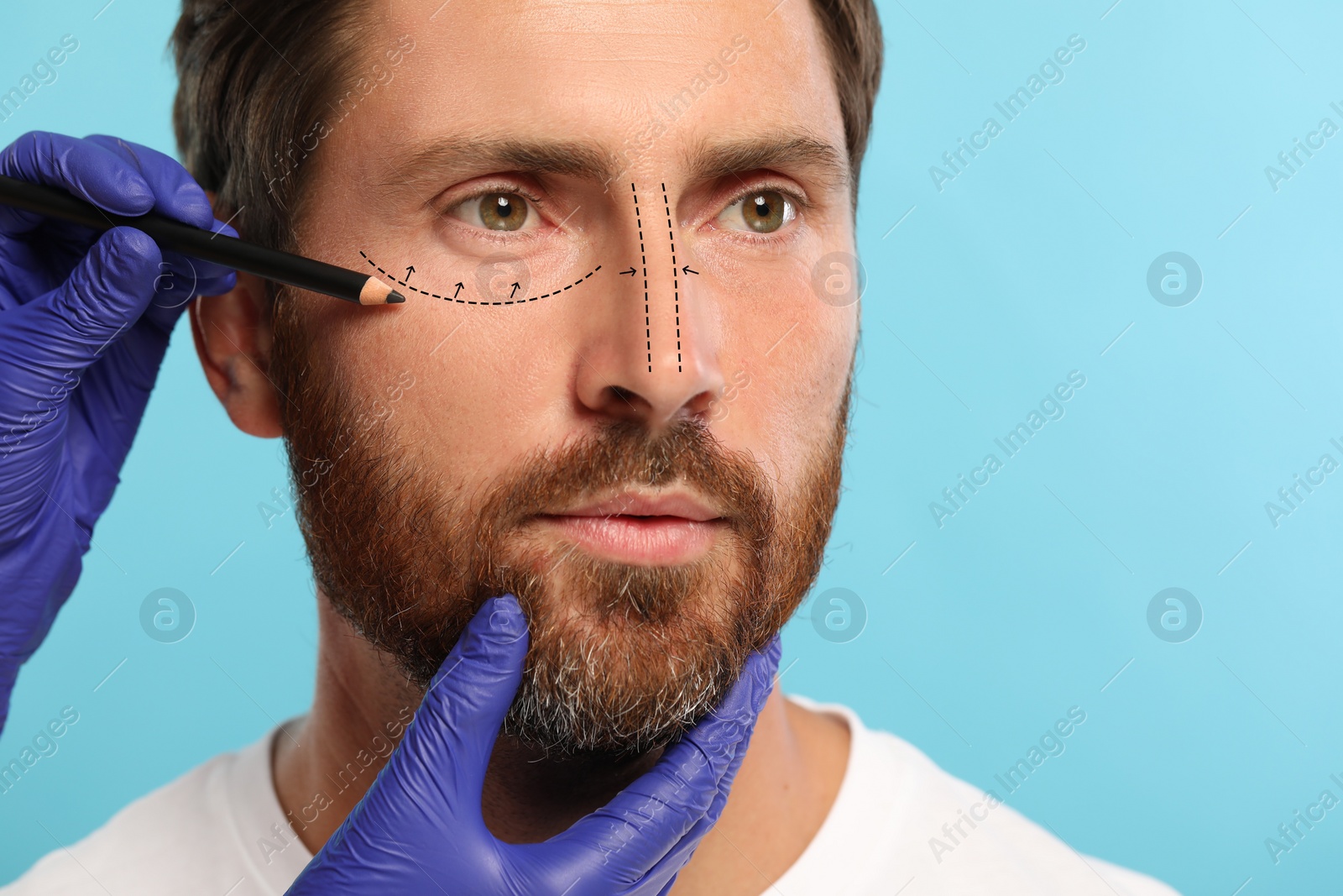 Image of Man preparing for cosmetic surgery, light blue background. Doctor drawing markings on his face, closeup