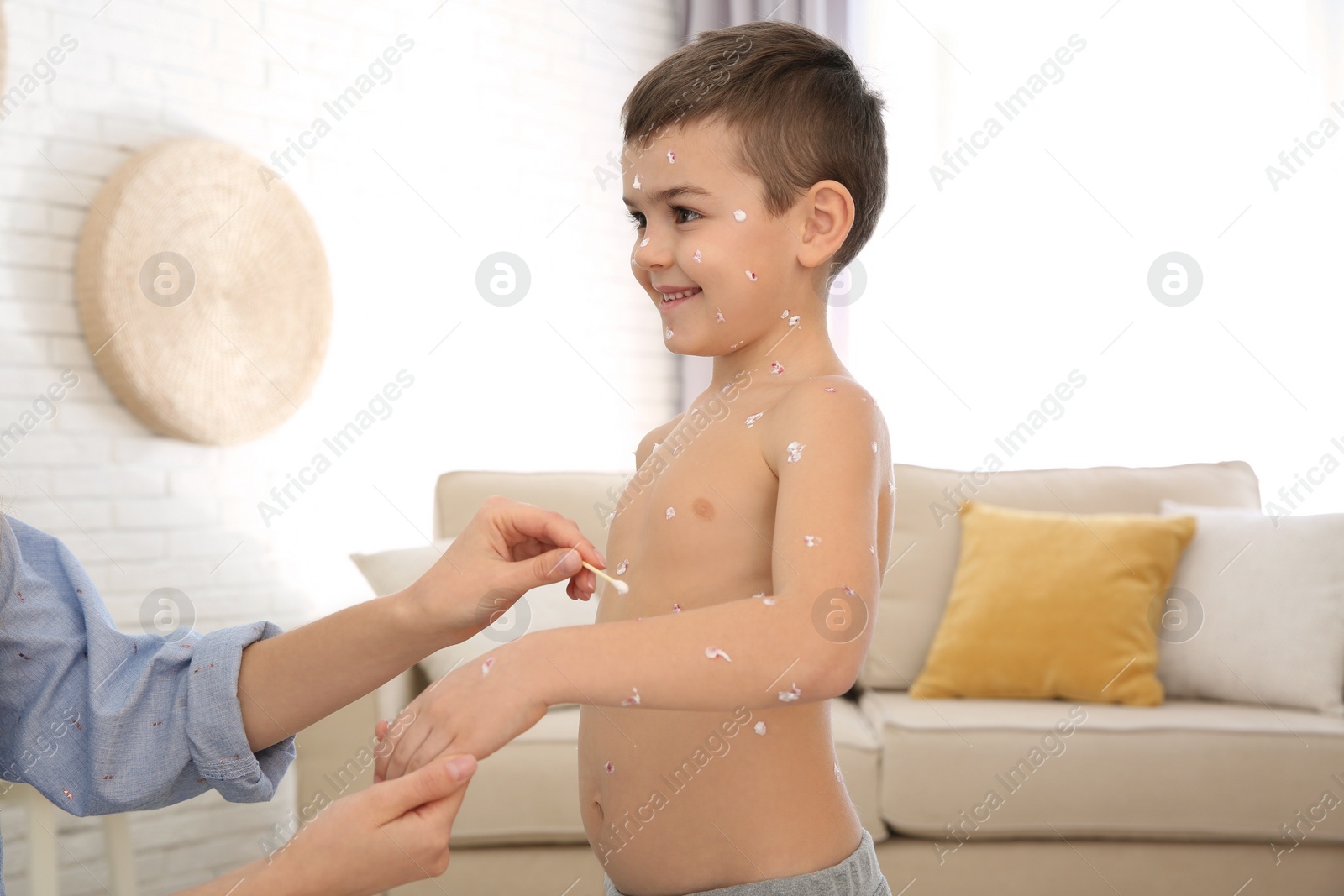 Photo of Woman applying cream onto skin of little boy with chickenpox at home