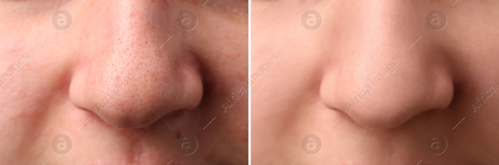 Image of Photos of woman before and after acne treatment, closeup. Collage showing affected and healthy skin