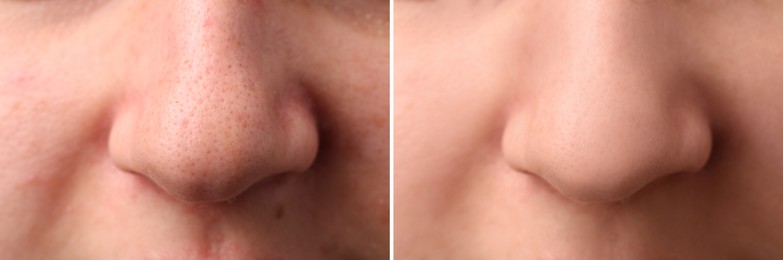 Image of Photos of woman before and after acne treatment, closeup. Collage showing affected and healthy skin