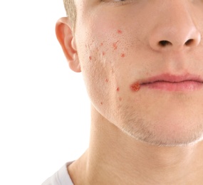 Young man with acne problem on white background