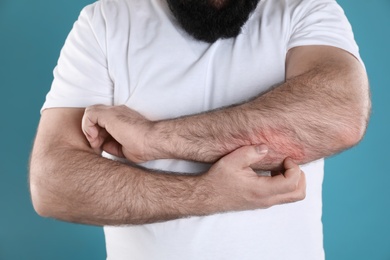 Photo of Man with allergy symptoms scratching forearm on color background, closeup