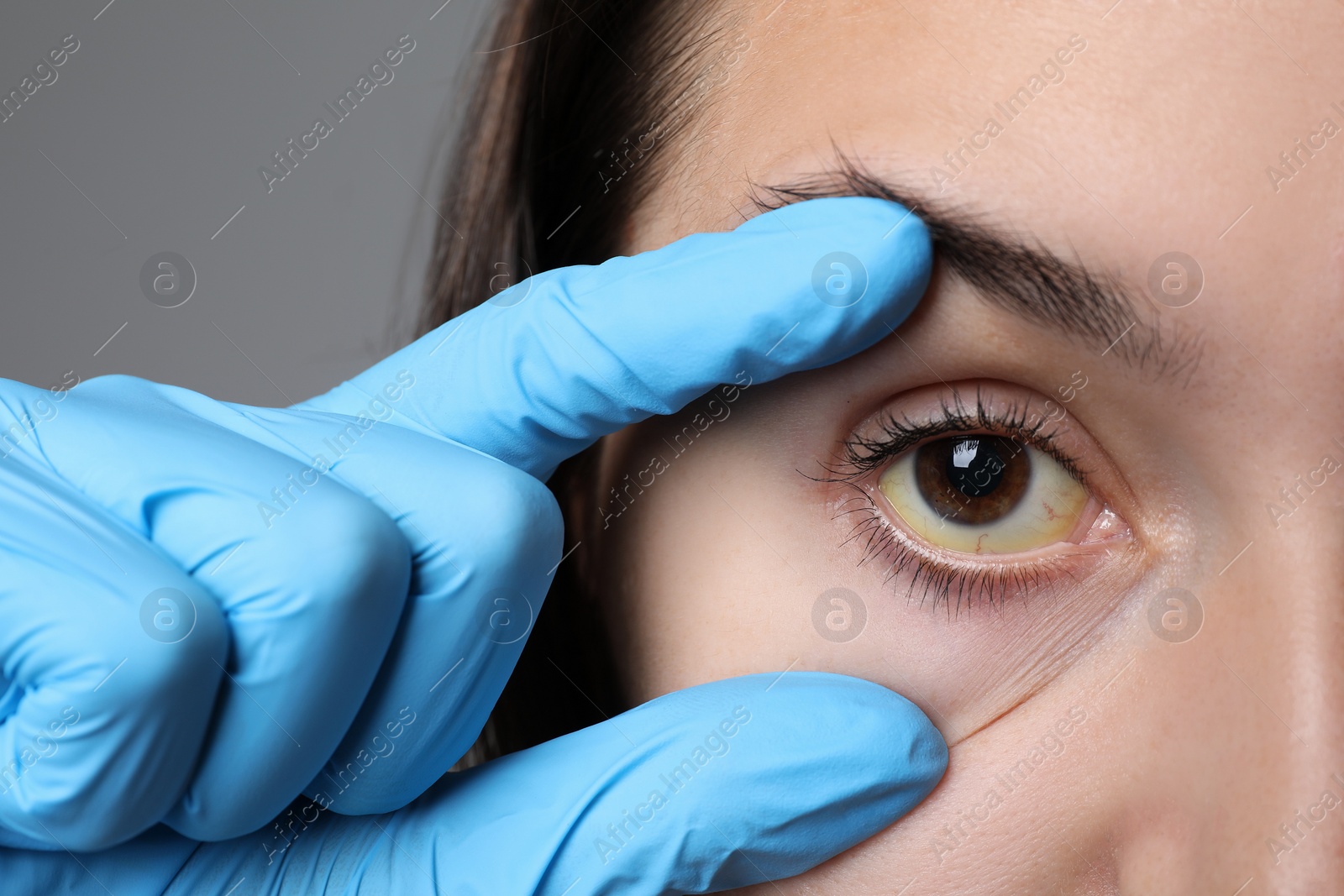 Photo of Doctor checking woman with yellow eyes on grey background, closeup. Symptom of hepatitis