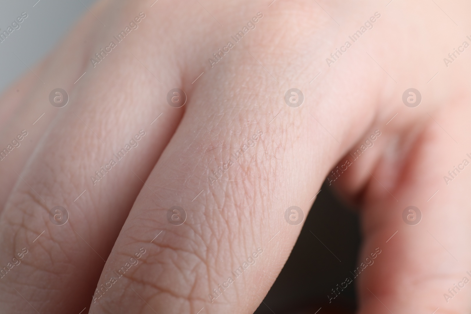 Photo of Woman with dry skin on hand, closeup