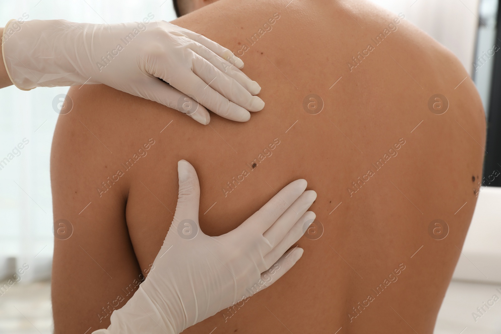 Photo of Dermatologist examining patient's birthmark in clinic, closeup