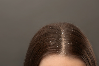Image of Woman with dandruff in her dark hair on grey background, closeup