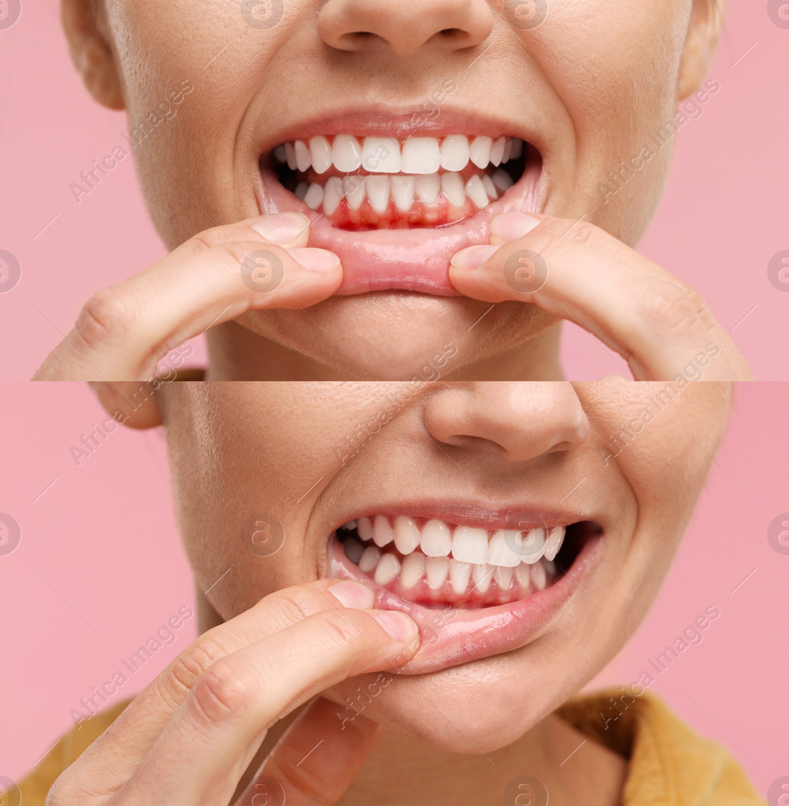 Image of Woman showing gum before and after treatment on pink background, collage of photos