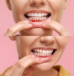 Woman showing gum before and after treatment on pink background, collage of photos