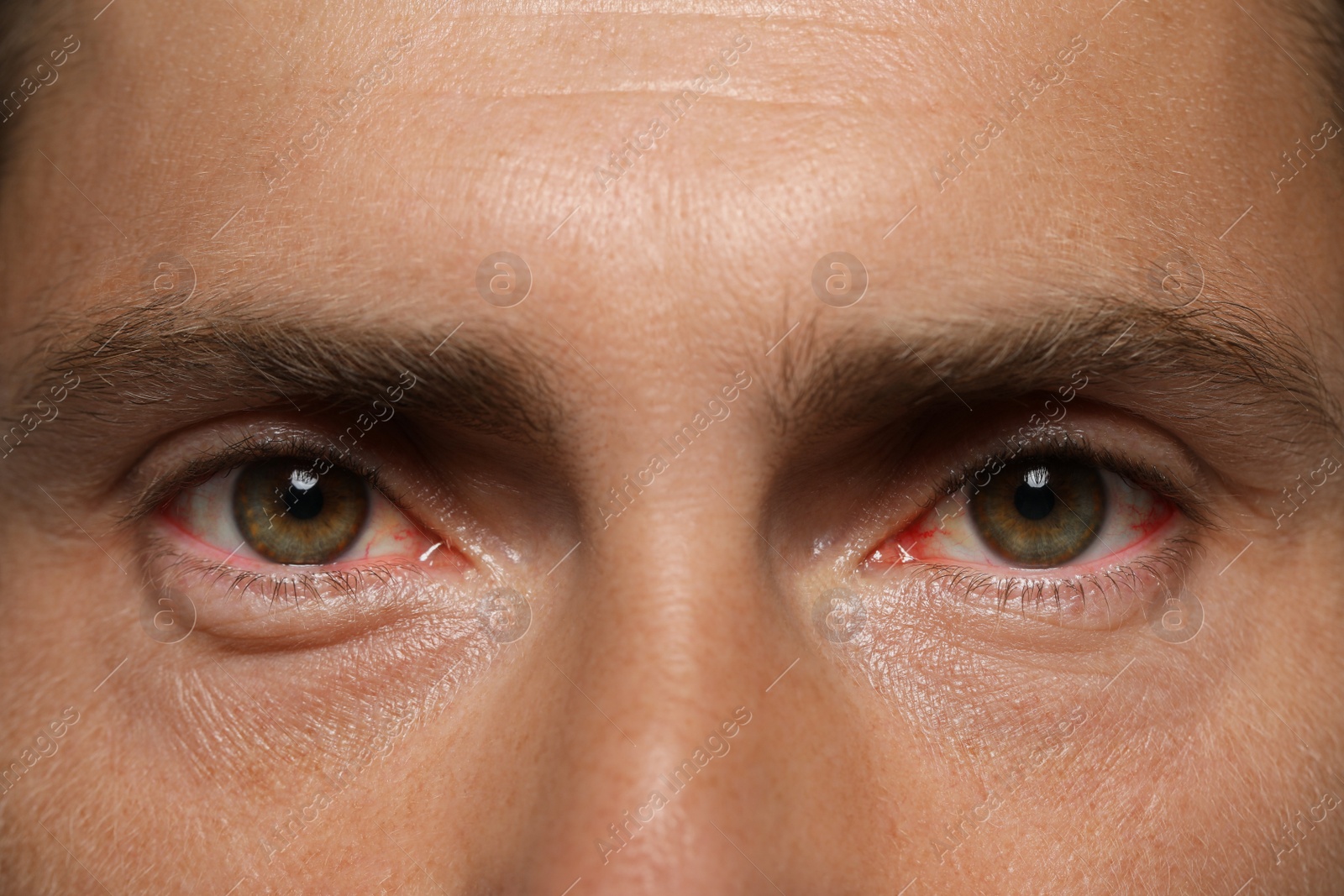 Image of Closeup view of man with inflamed eyes