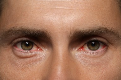 Image of Closeup view of man with inflamed eyes