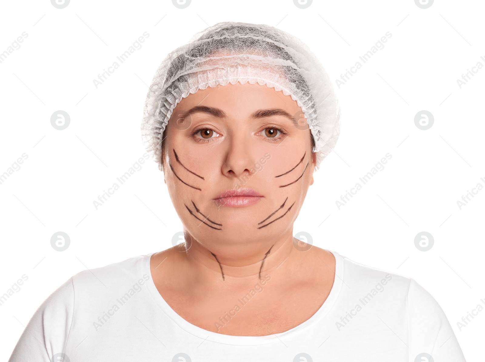 Photo of Woman with double chin ready for cosmetic surgery operation on white background