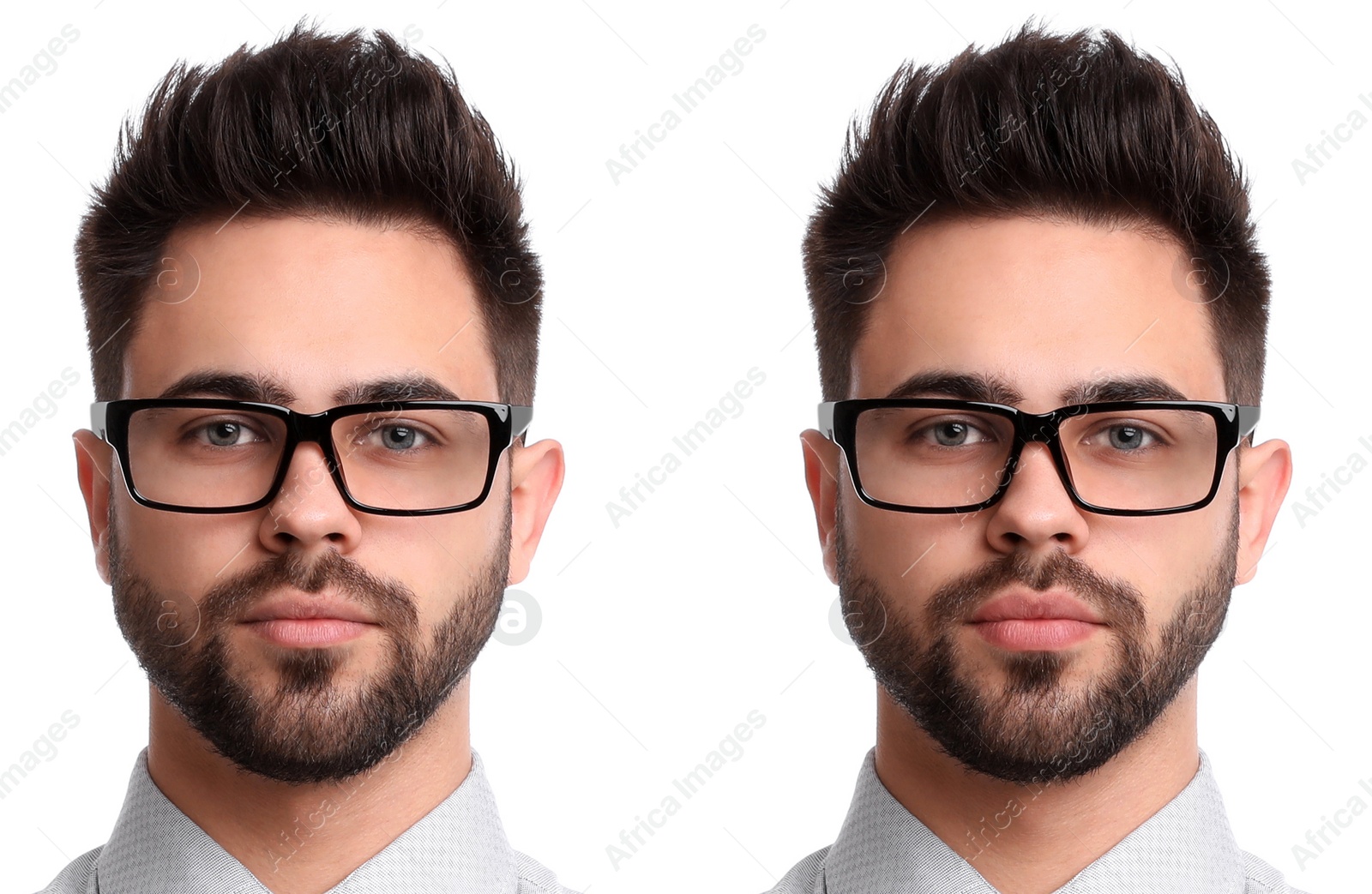 Image of Collage with photos of man before and after lips augmentation on white background