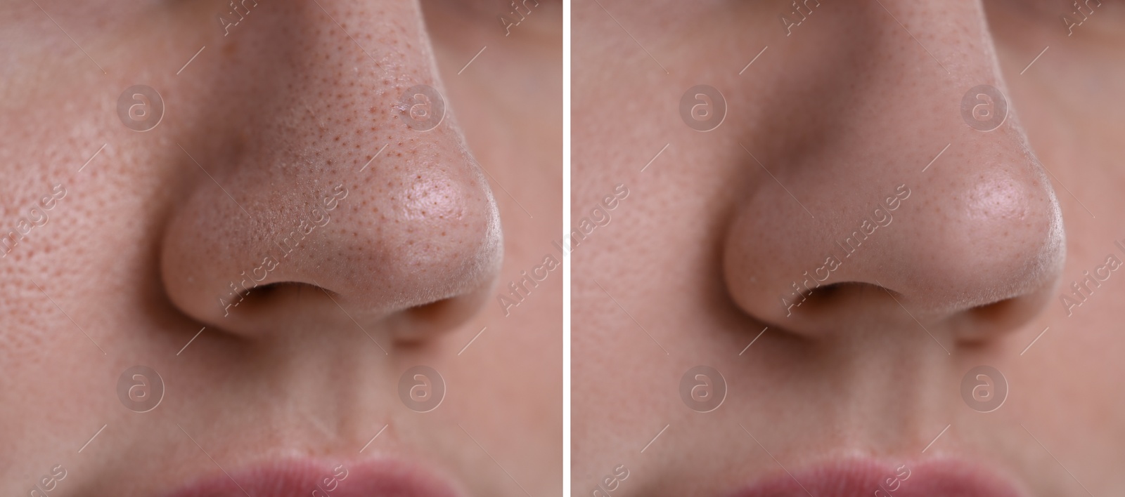 Image of Blackhead treatment, before and after. Collage with photos of woman, closeup view