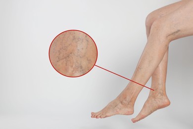 Image of Woman suffering from varicose veins on light background, closeup. Magnified skin surface showing affected area