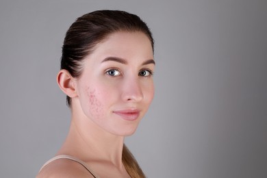 Young woman with acne problem on light grey background. Space for text