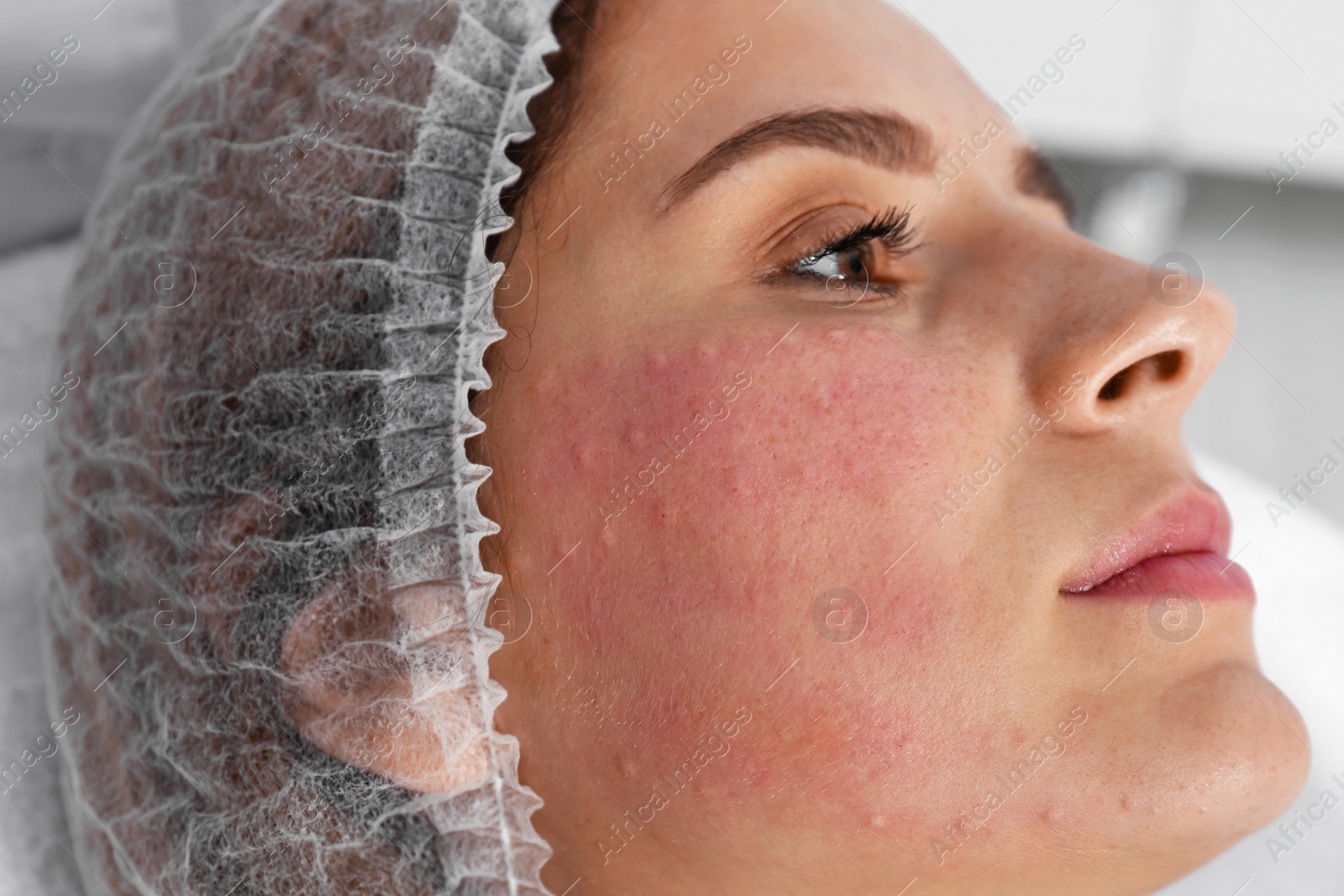 Photo of Woman after face biorevitalization procedure in salon, closeup. Cosmetic treatment