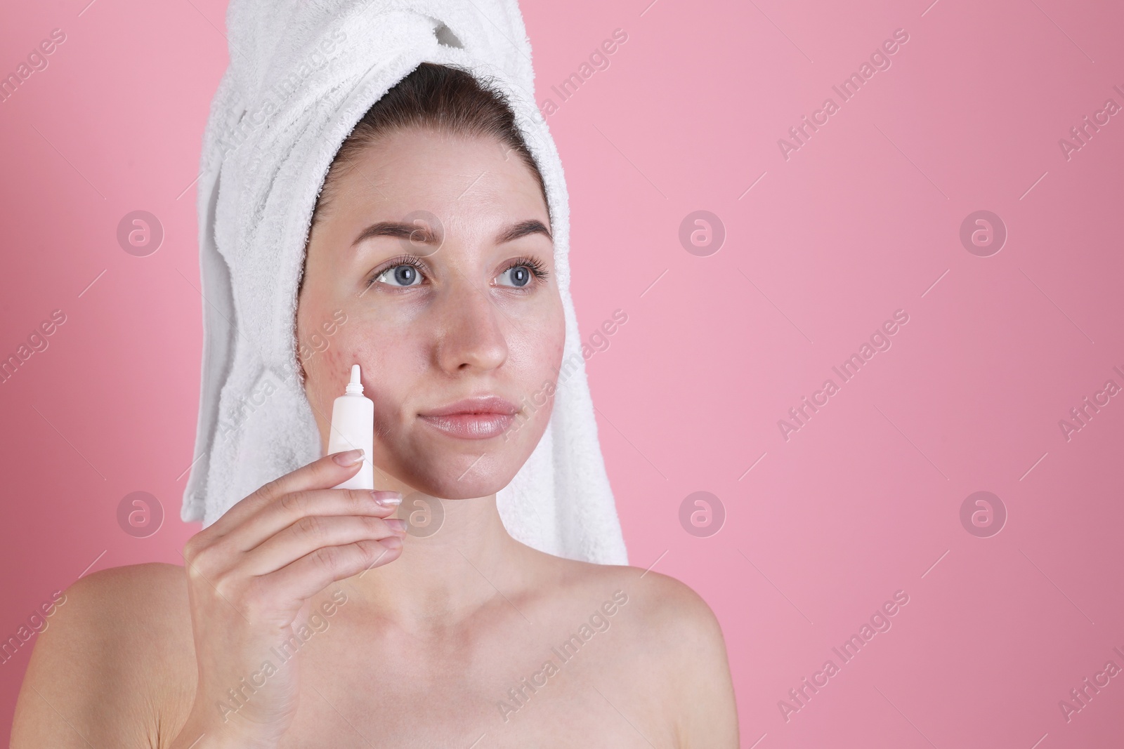 Photo of Young woman with acne problem applying cosmetic product onto her skin on pink background. Space for text