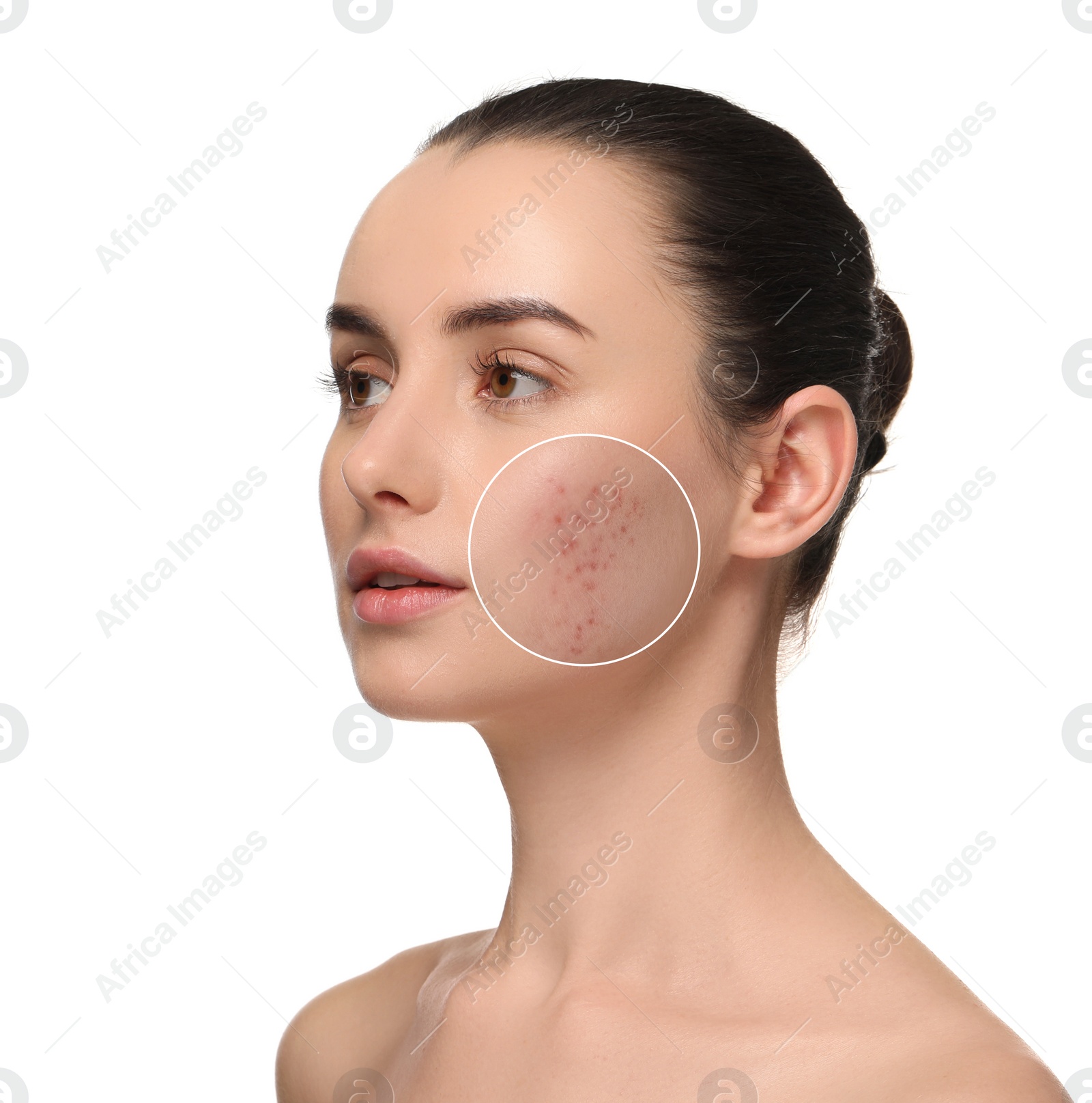 Image of Woman with acne on her face on white background. Zoomed area showing problem skin