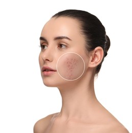 Image of Woman with acne on her face on white background. Zoomed area showing problem skin