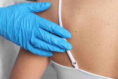 Dermatologist examining patient's birthmark in clinic, closeup