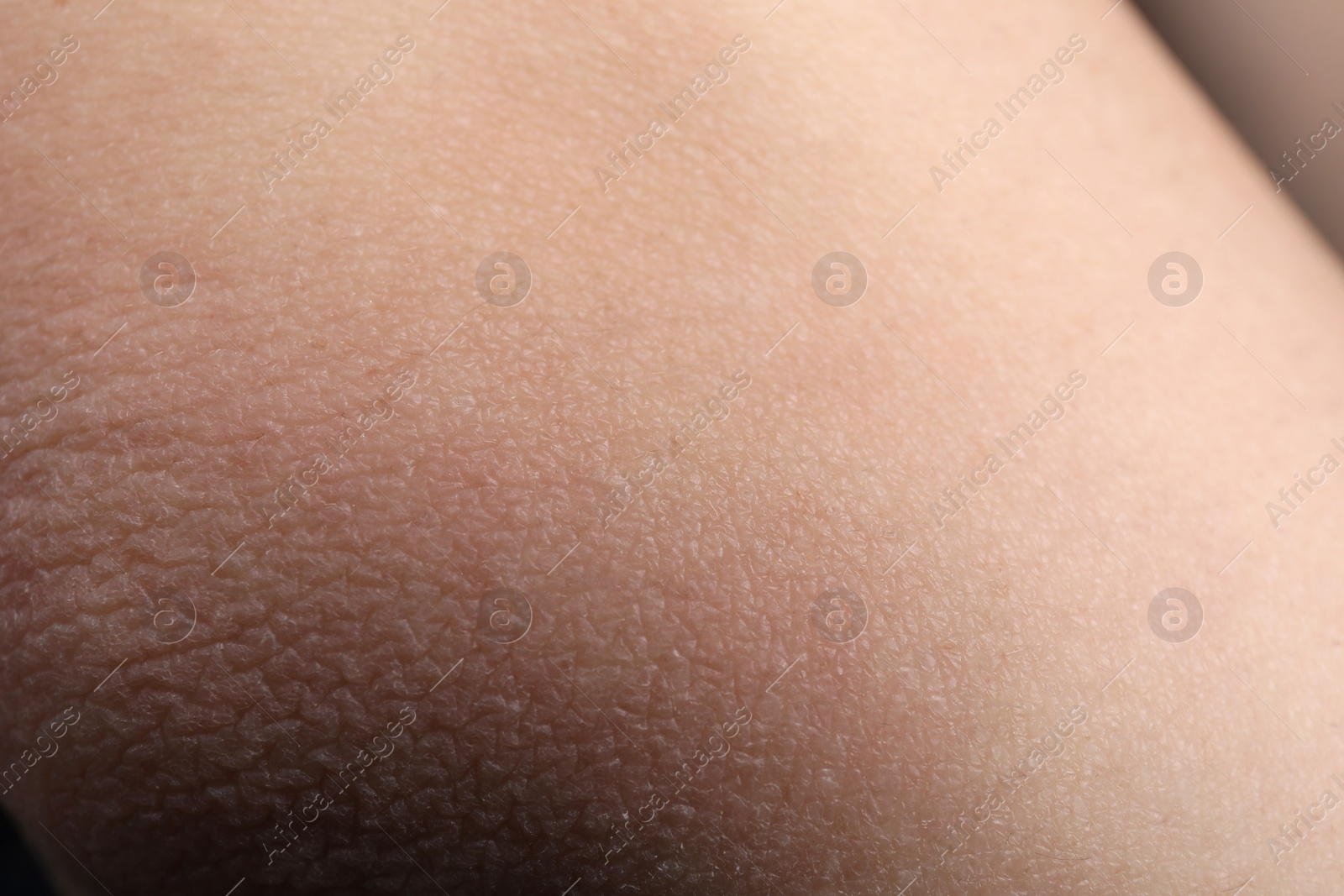 Photo of Woman with dry skin on elbow, closeup